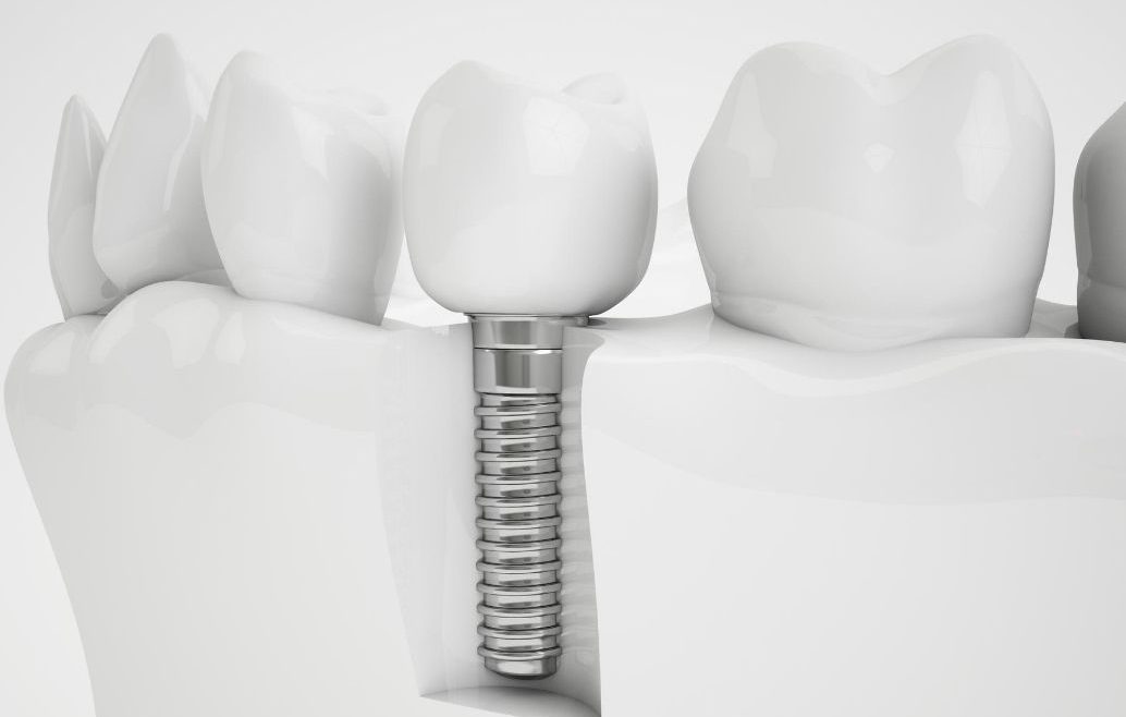 Ortodoncia e implantes