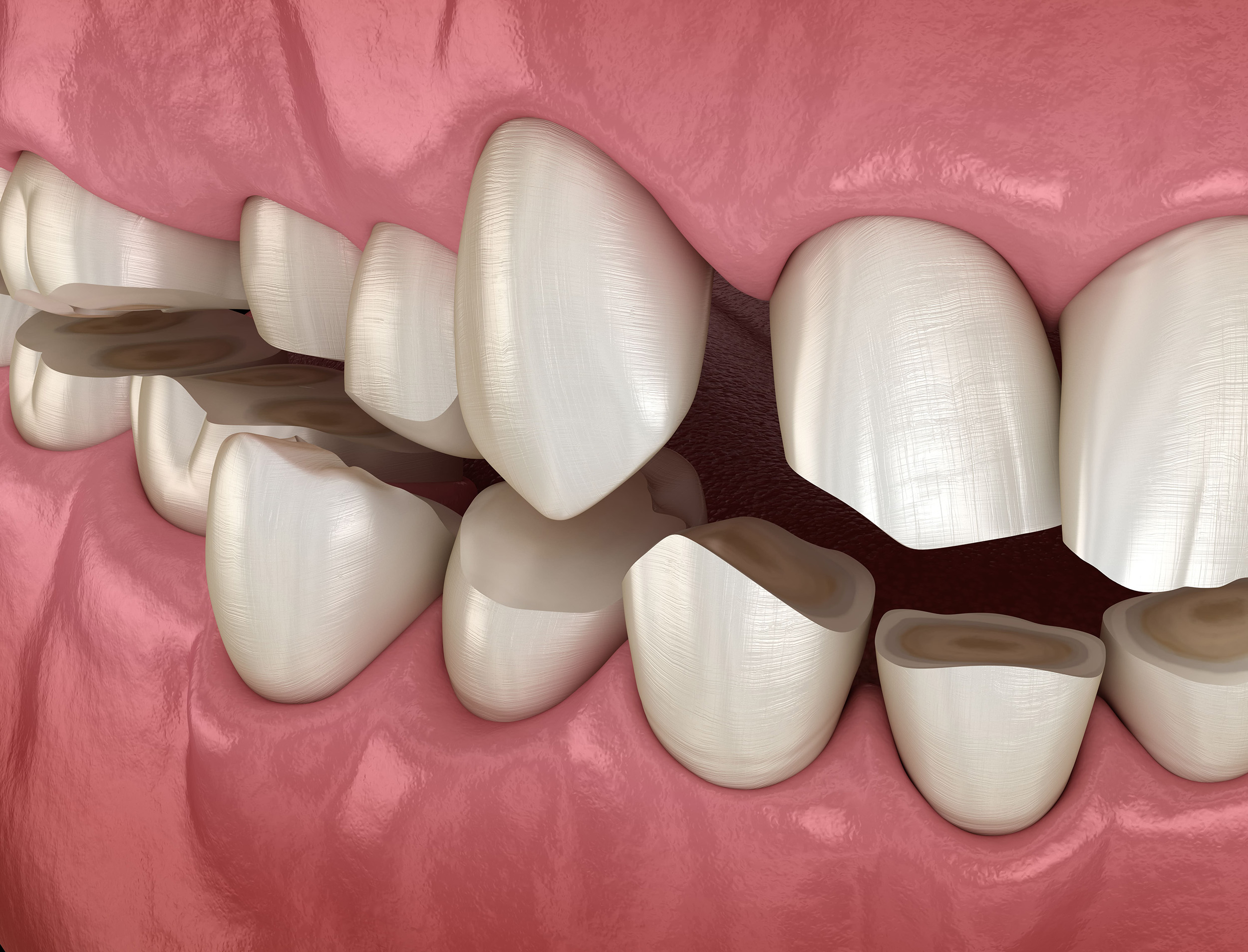 Las férulas de retención de ortodoncia, ¿me sirven como placa de descarga?