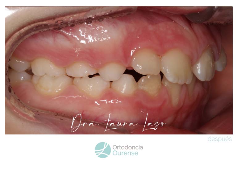 Compresión maxilar después. Clínica dental Ortodoncia Ourense. Doctora Laura Laso
