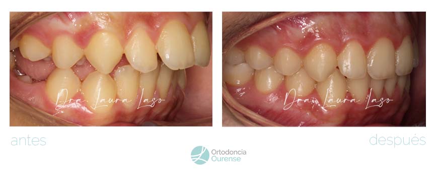 caso de dispositivo mandibular. doctora Laura Laso. Ortodoncia Ourense. Ortodoncia para niños en Ourense