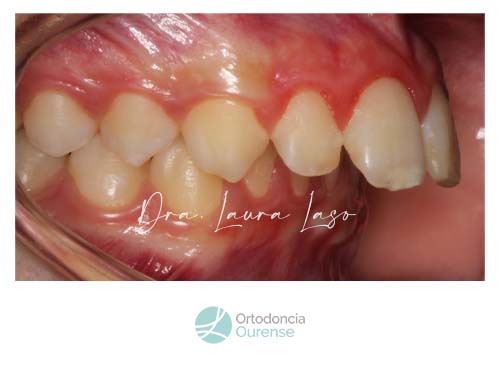 dispositivo de avance mandibular. fotografía inicial. Ortodoncia Ourense