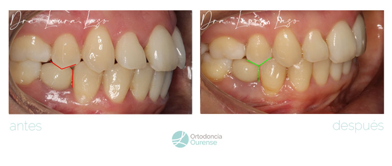 agenesia y correcion de diastema mediante ortodoncia invisible invisalign para dientes separados