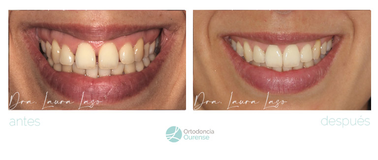 Corrección de sonrisa con dientes separados mediante tratamiento invisaling. Ortodoncia en Ourense