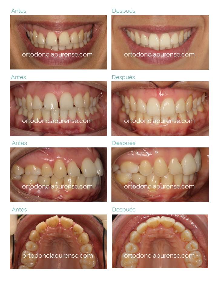 ortodoncia con diastemas ortodoncia ourense