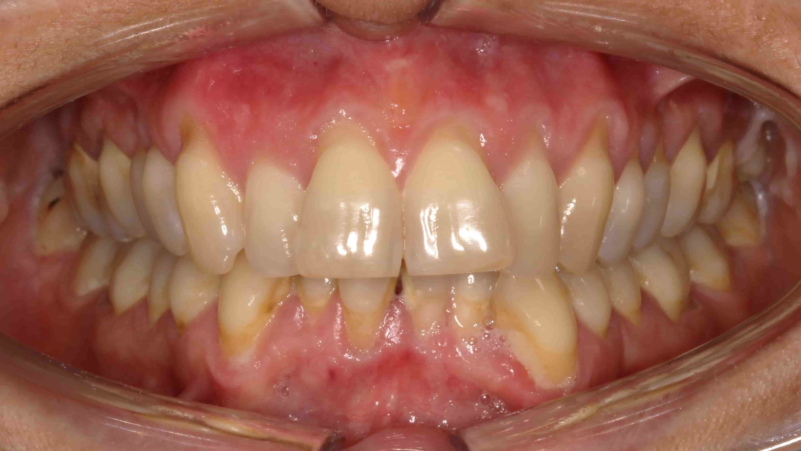 invisalign ourense ortodoncia ourense laura laso antes y despues ortodoncia invisible spark-min