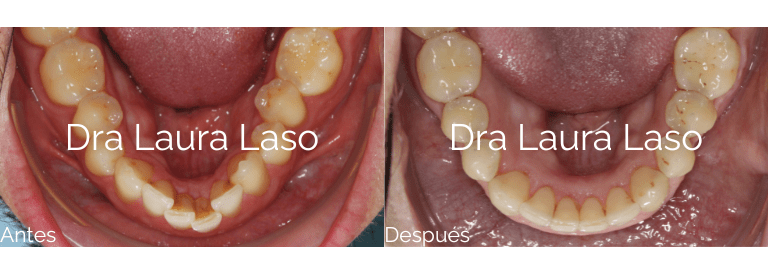 Invisalign, Arte Oral Odontologia Especializada