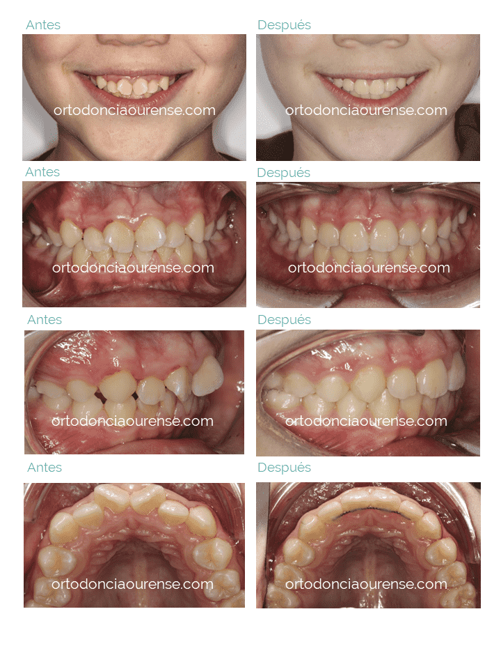 antes y después de la corrección de los dientes de un adolescente