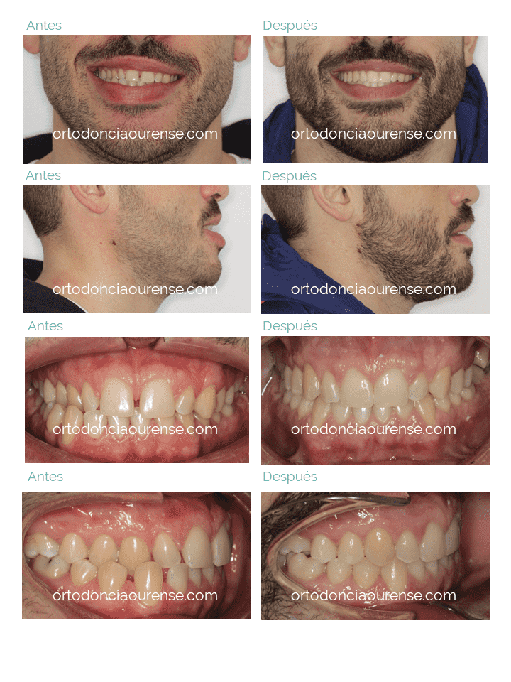 antes y después de la corrección de una mordida cruzada con ortodoncia invisible invisalign