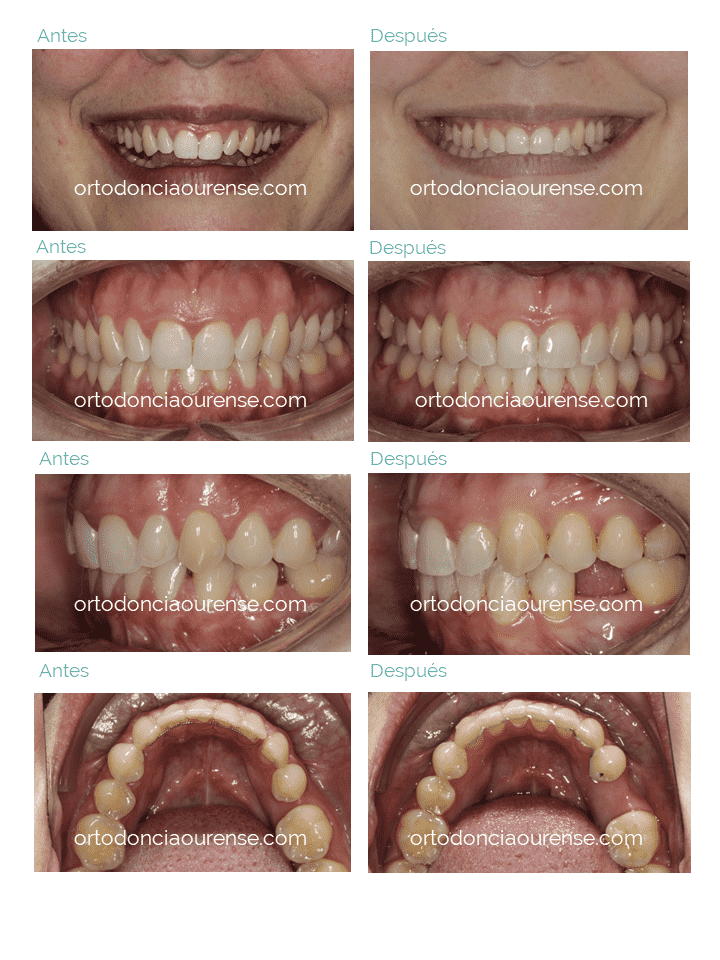 dientes antes y después de paciente de clínica dental de ortodoncia