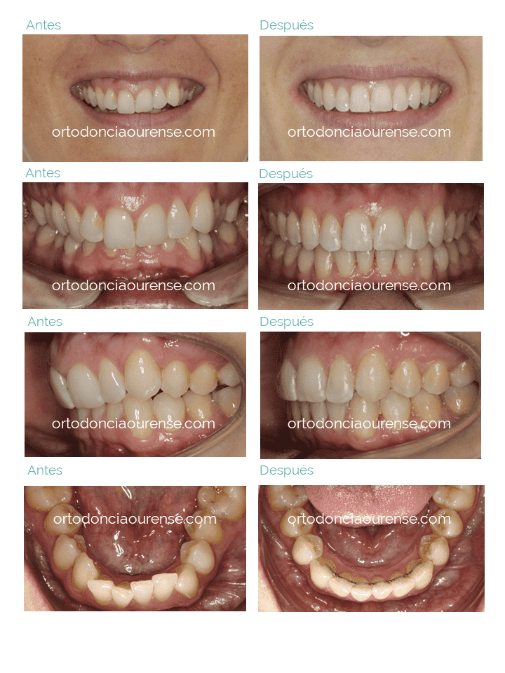 antes y después de tratamiento con brackets personalizados insignia