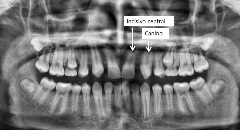 agenesia dental 