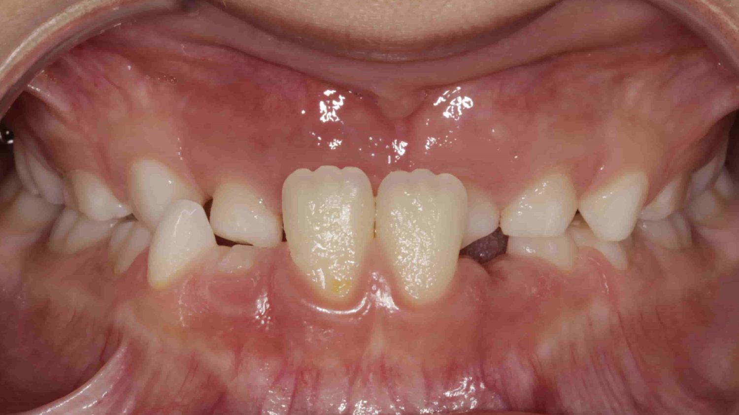 Prognatismo mandibular ejemplo