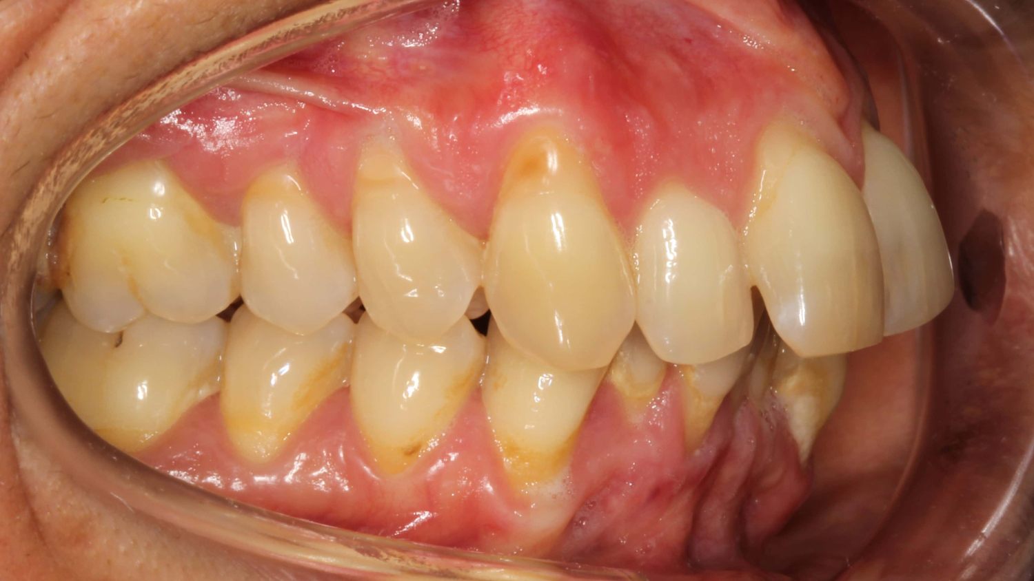 retrognatismo mandibular