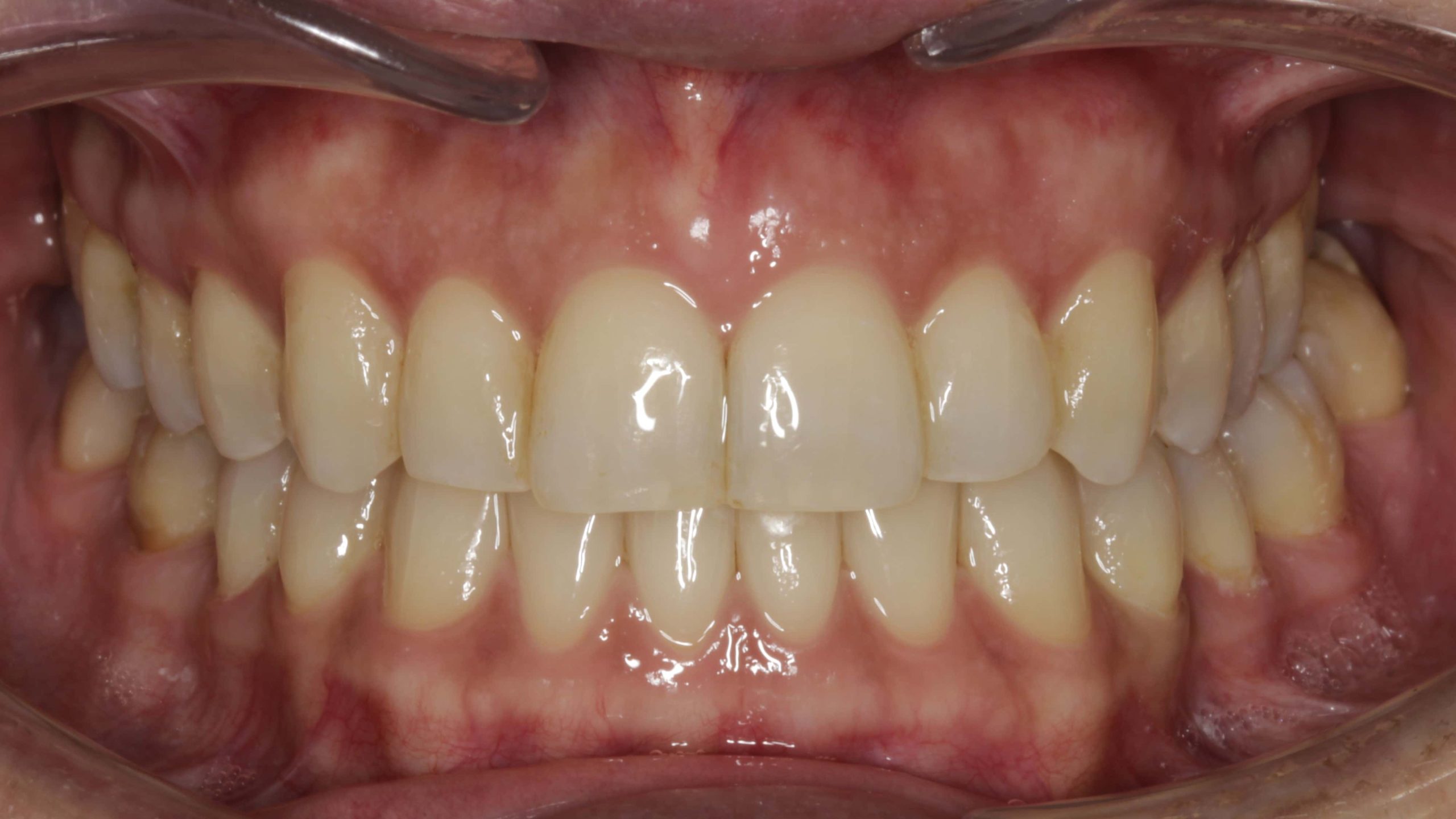 clinica dental ourense sonrisa antes y después