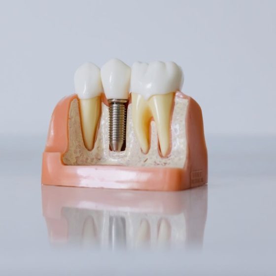 periimplantitis síntomas