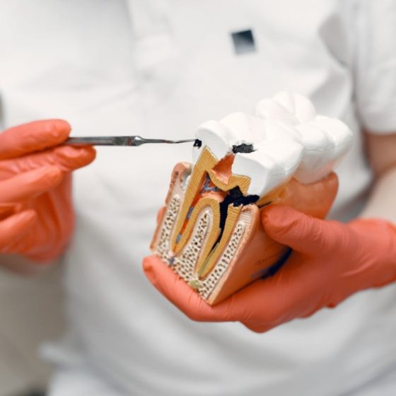 Por qué salen las caries