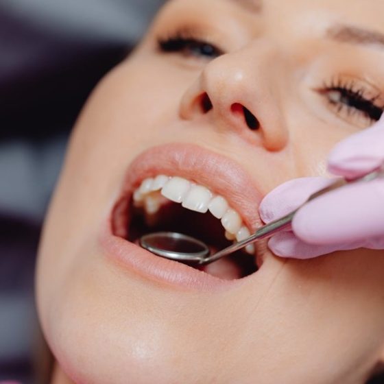 caries