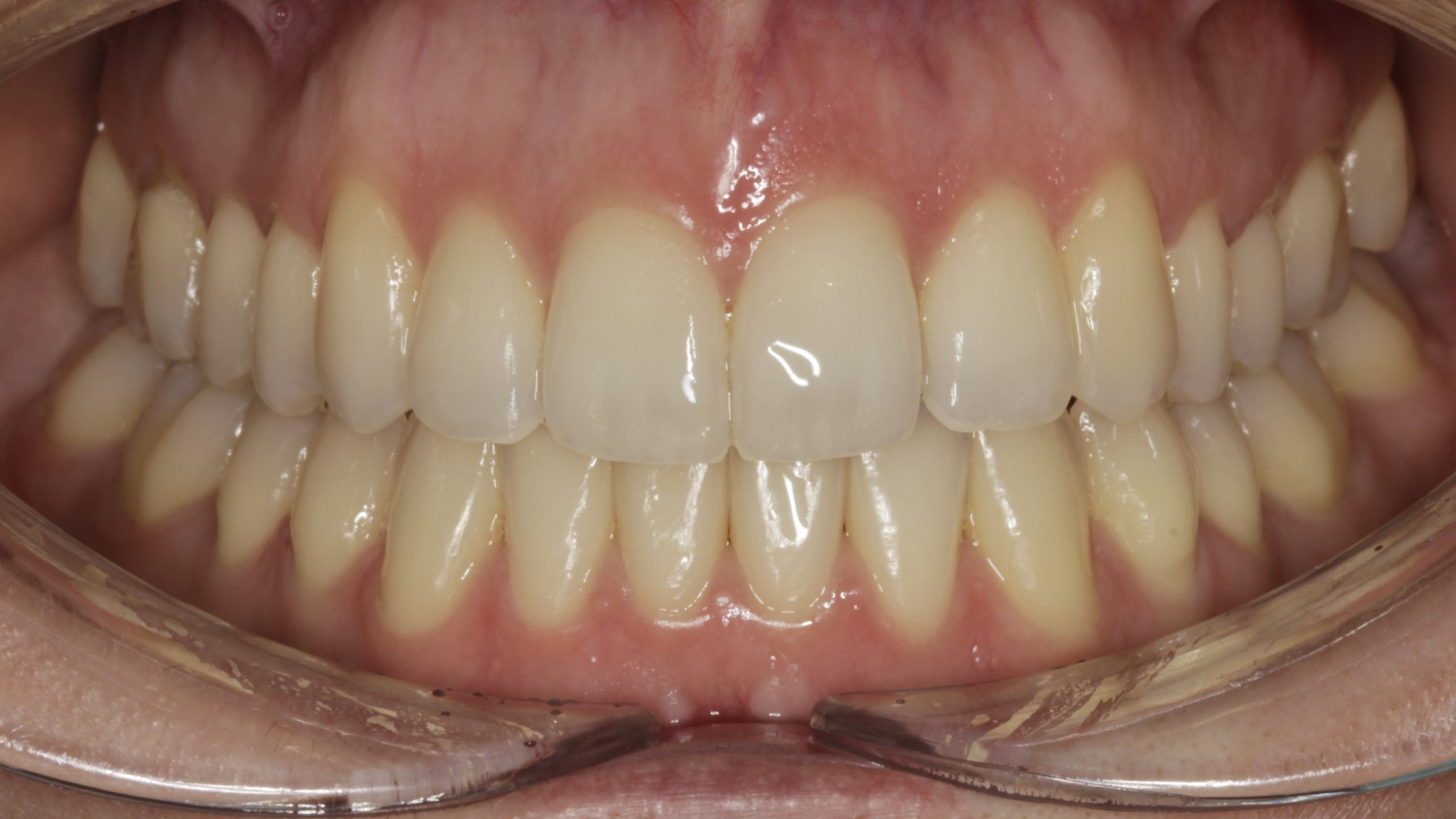 After image